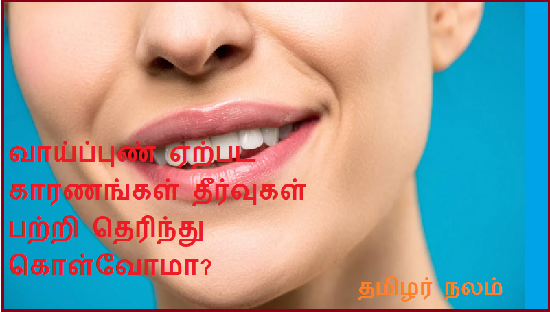 வாய்ப்புண் ஏற்பட காரணங்கள் தீர்வுகள் பற்றி தெரிந்து கொள்வோமா | Let's know about possible causes and solutions