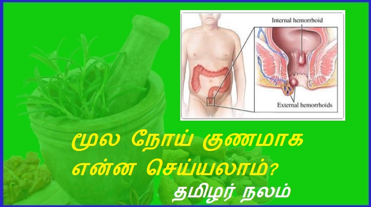 மூல நோய் குணமாக என்ன செய்யலாம்? | What can be done to cure hemorrhoids?